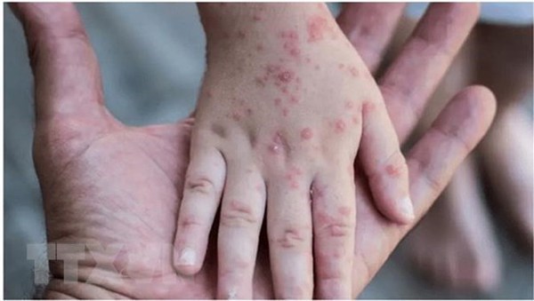 WHO to continue to support Vietnam in monkeypox prevention, response: Representative hinh anh 2