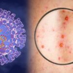 Ministry preparing response plans for monkeypox hinh anh 1