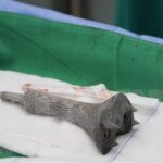 Cho Ray Hospital successfully applies new technique in bone surgery hinh anh 1