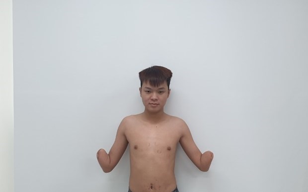 Double forearm transplant: New miracle of Vietnam’s health sector hinh anh 2