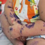 HCM City sees surge in hand, foot and mouth infections hinh anh 1